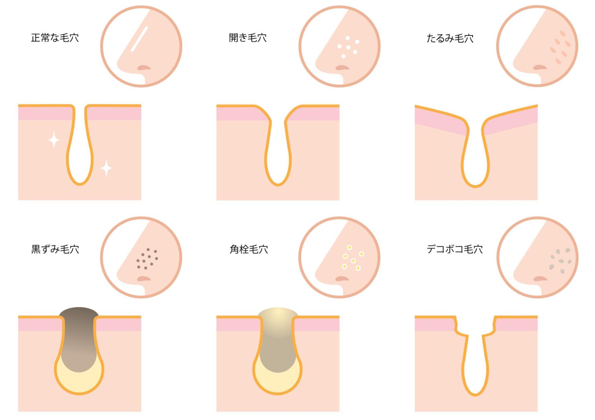 20代で毛穴が開く理由とは？対処法ややっておくべき美容医療を紹介