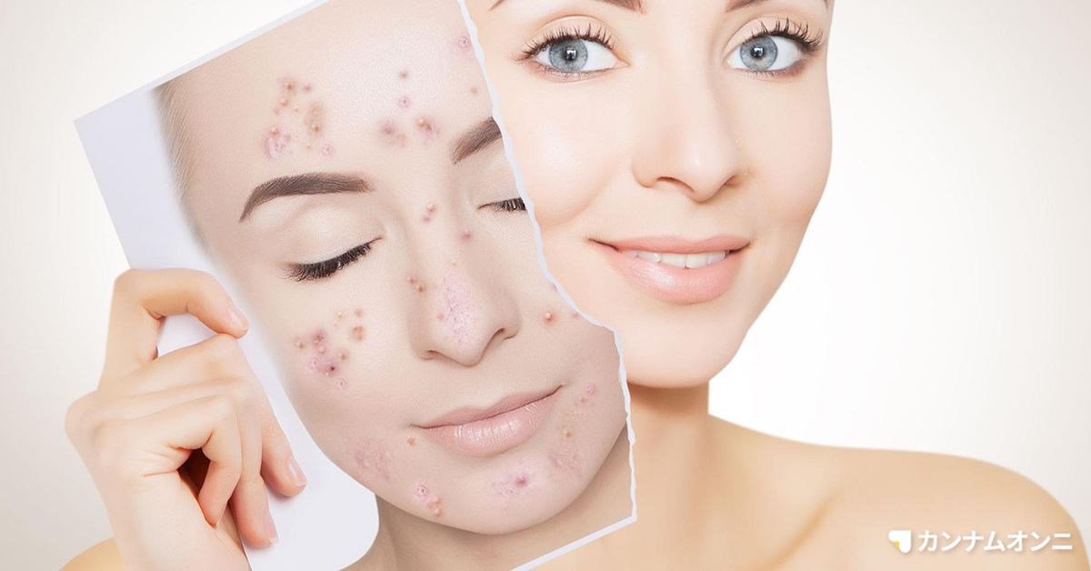 ハイドラフェイシャルはニキビに効果ある 悪化しない 上手なケア方法 カンナムオンニ