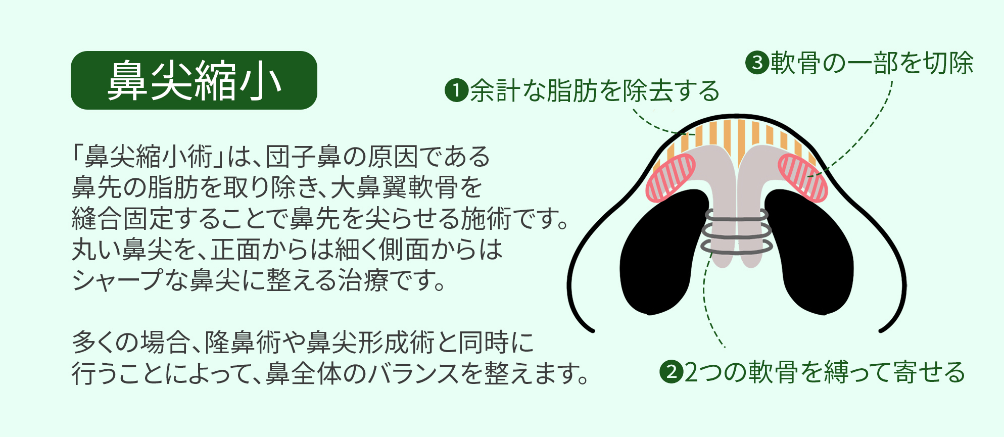 鼻整形の悩み別おすすめ施術！7つの切る手術と4つの切らない施術を解説, image size:1987x865